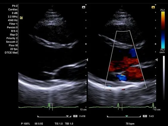 Клинические изображения Siemens Acuson NX2 аппарат УЗИ