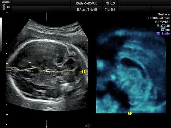 Клинические изображения УЗИ аппарат GE HealthCare Voluson P8