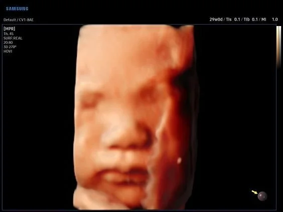 V6-RUS: Лицо плода, RealisticVue, 3D