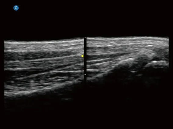 Клинические изображения Chison SonoTouch 30 портативный УЗИ аппарат