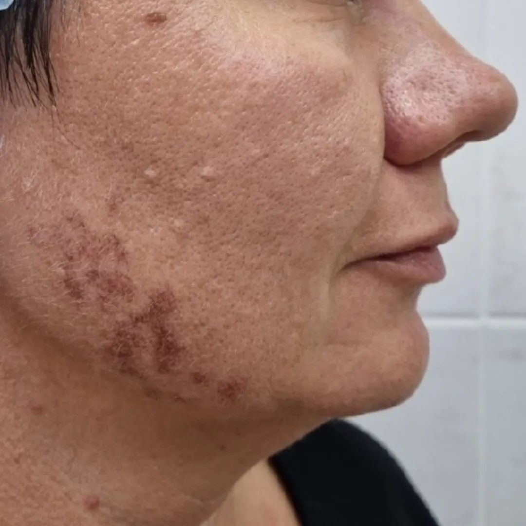 NeoGen омоложение право до.jpg NeoGen омоложение право до.jpg