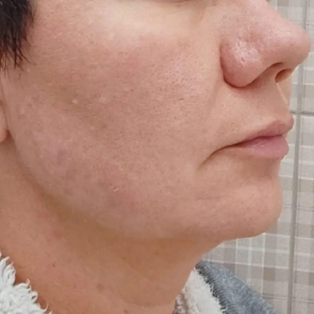 NeoGen омоложение право после.jpg NeoGen омоложение право после.jpg