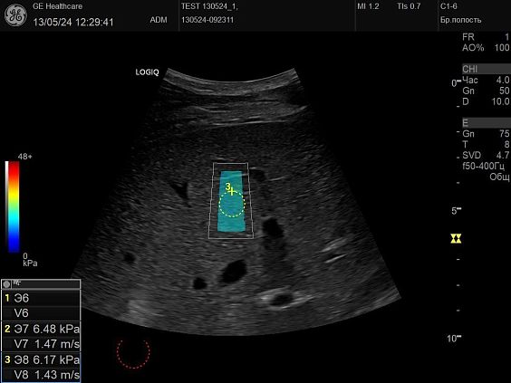 GE HealthCare Logiq P10 ультразвуковой аппарат