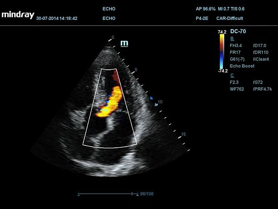 Mindray DC-70 Pro X-insight УЗИ аппарат